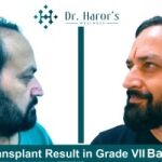 Hair transplant in delhi